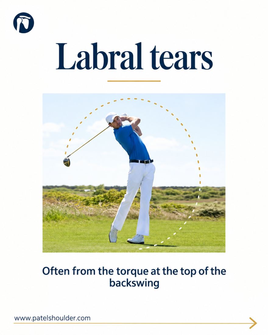 Social post for Dr. Patel on labral tears in golfers